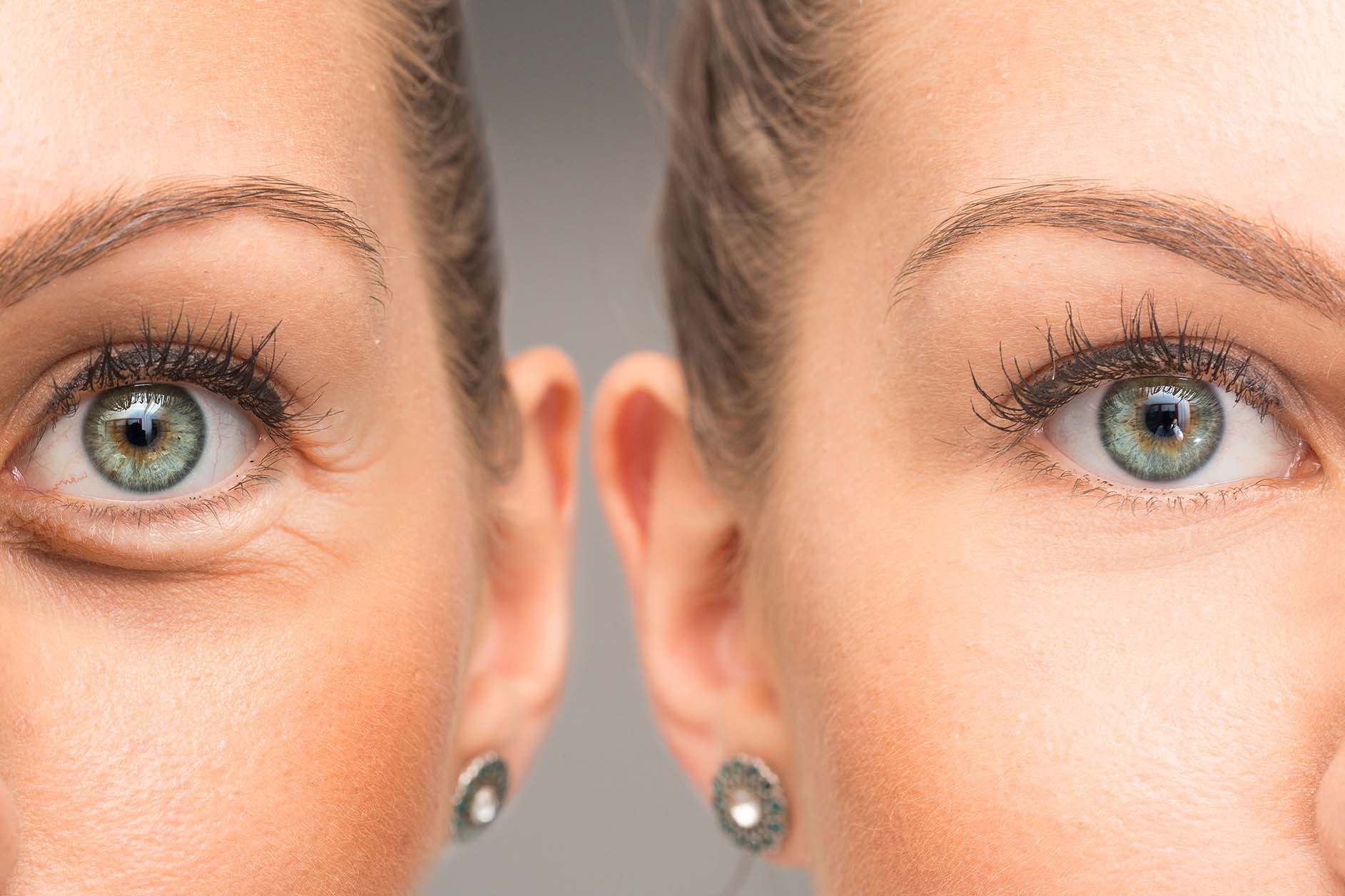 before and after eyelid lift