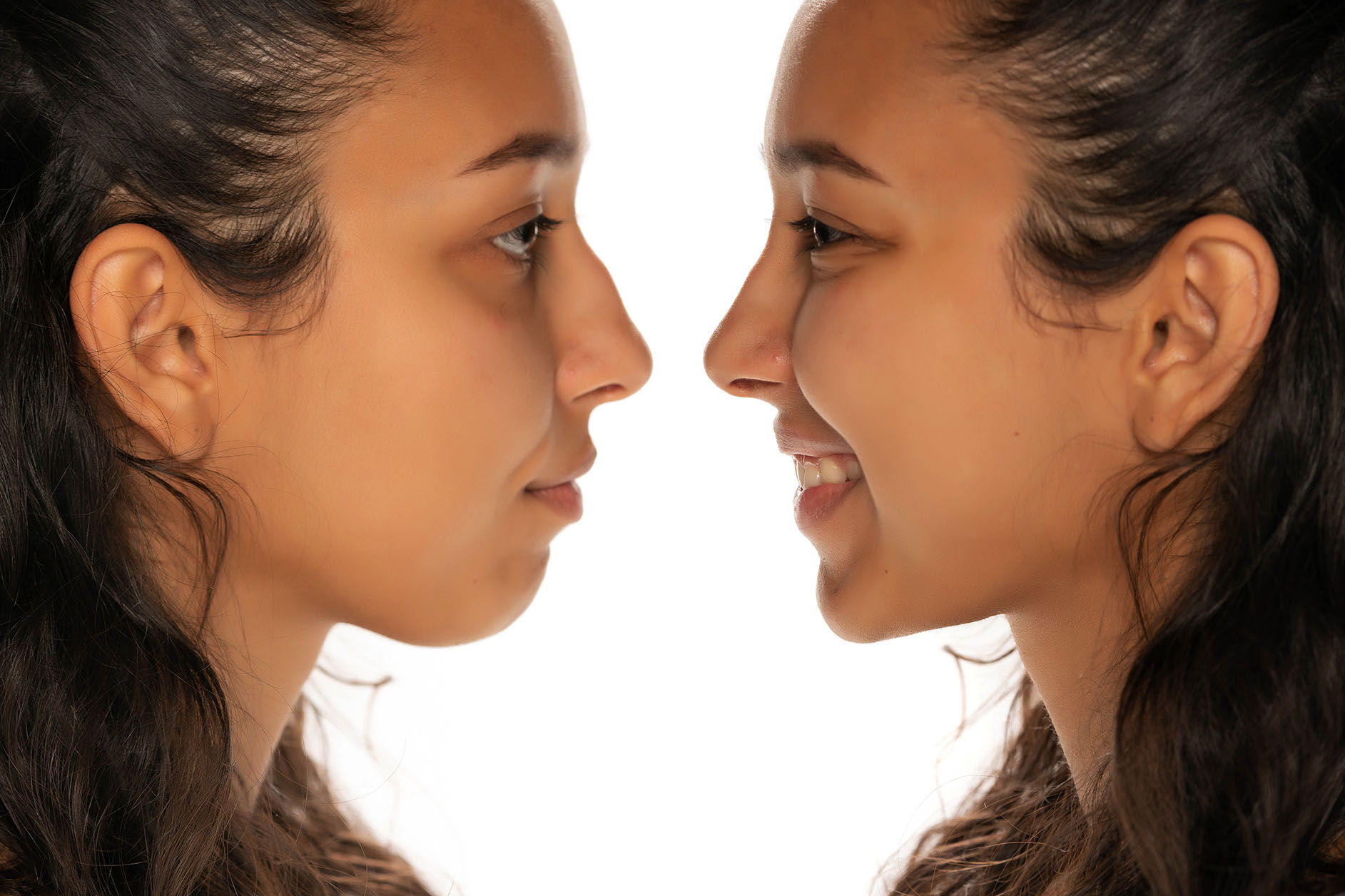 rhinoplasty before and after